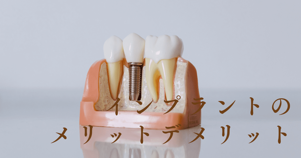 インプラントのメリットデメリット「元歯科技工士が解説」