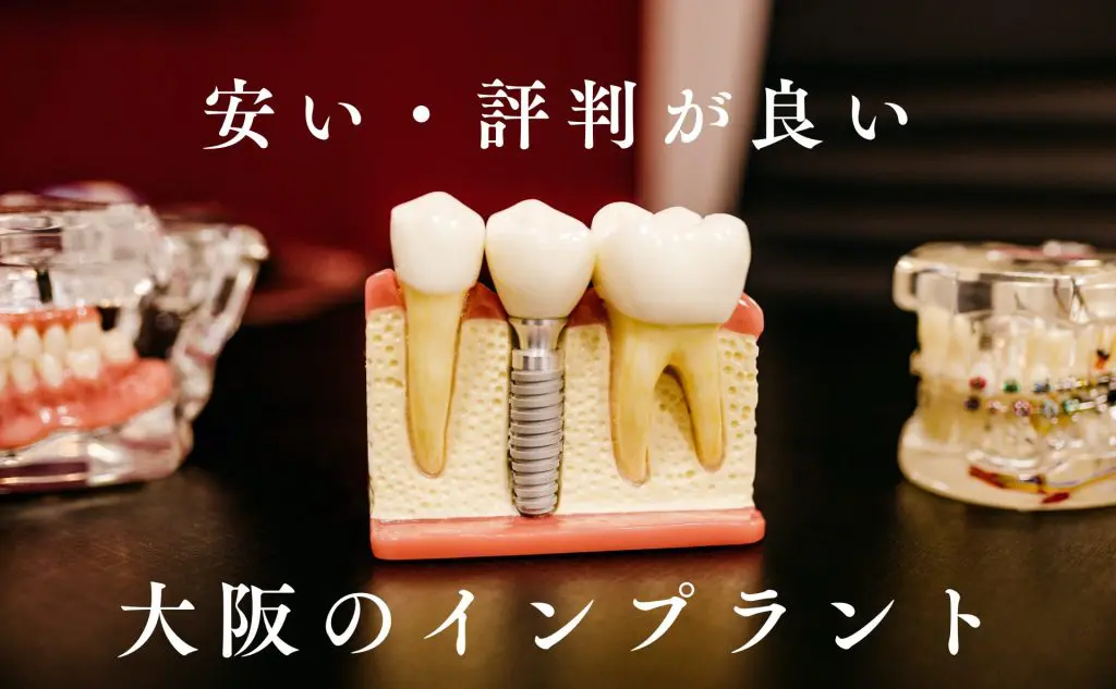 大阪のインプラントで安い・おすすめの歯医者さんは？